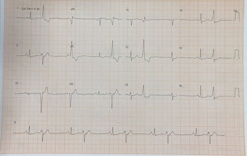 bigeminismo ventricular