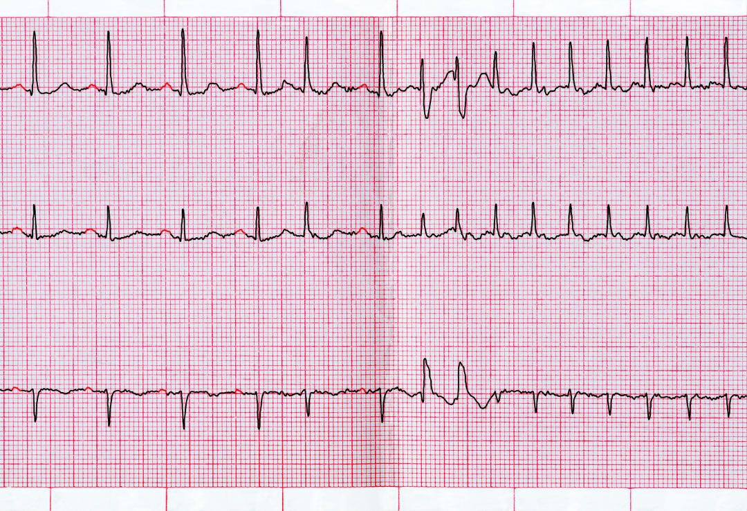 fibrila-o-atrial-no-atleta-clube-da-cardio